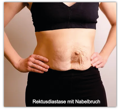 Rektusdiastase mit Nabelbruch